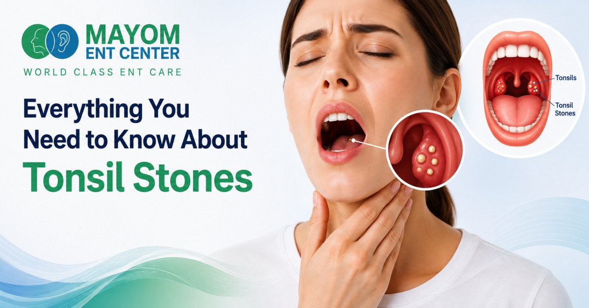 Everything You Need to Know About Tonsil Stones