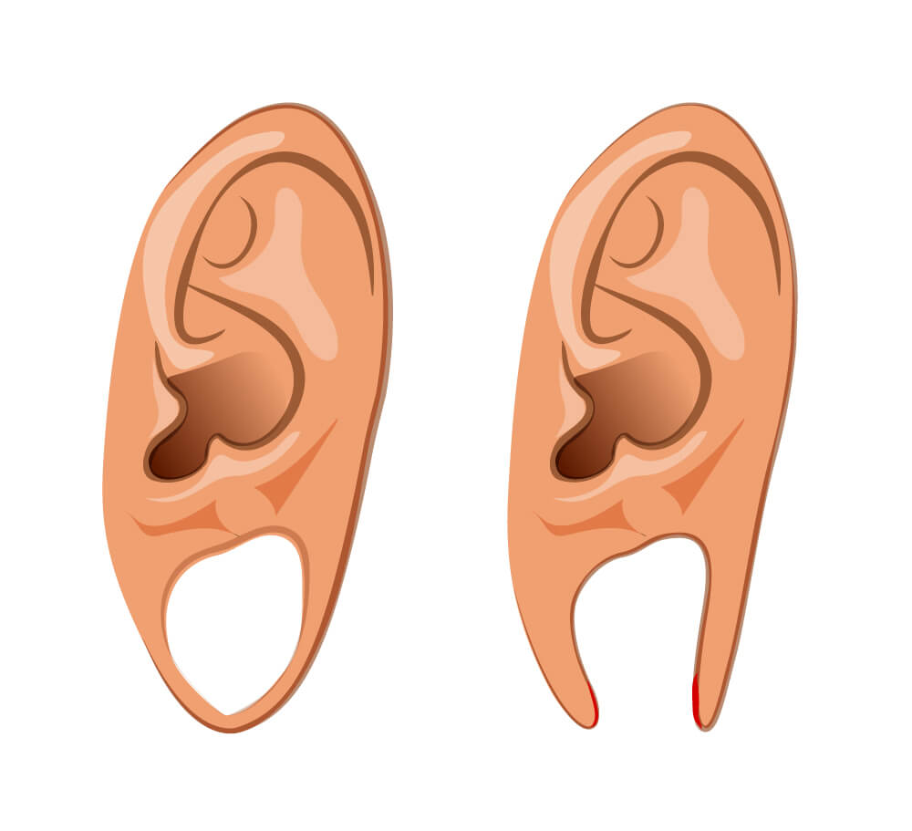 Split Earlobe - Professional ENT Care