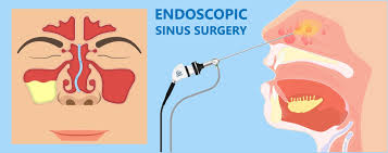 Endoscopic Sinus Surgery