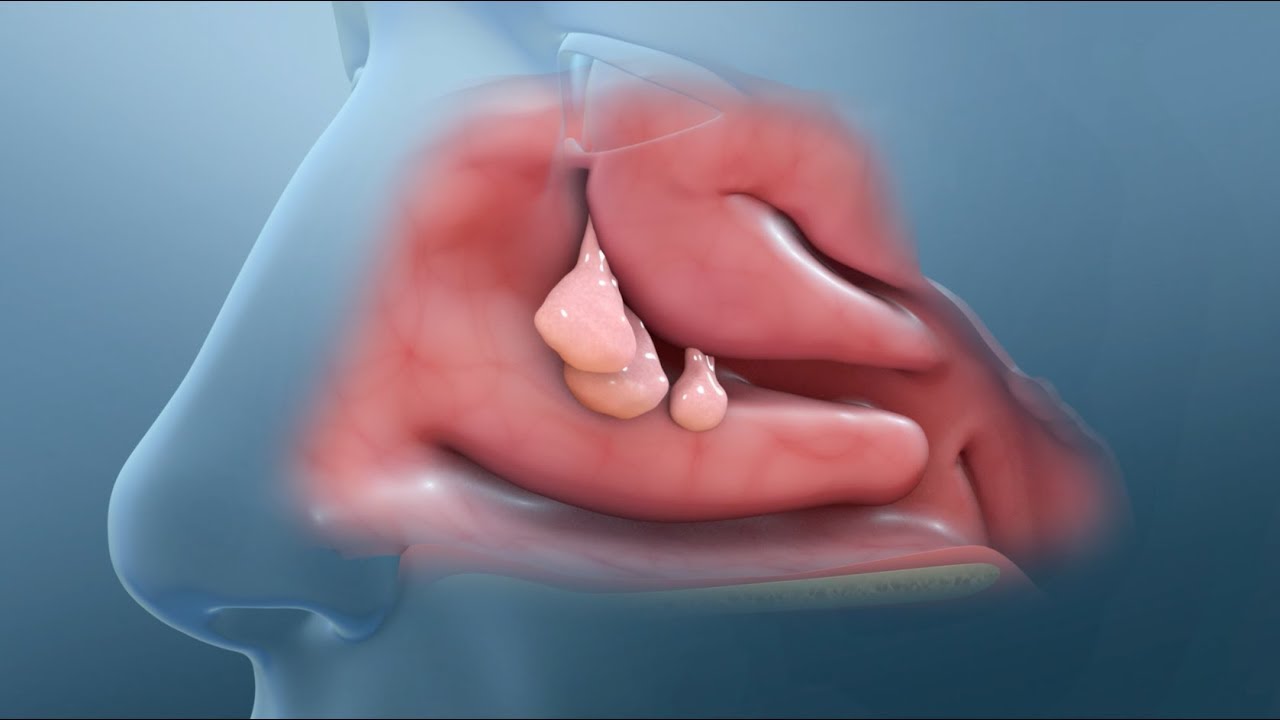 Polyp Surgery by Power Shaver