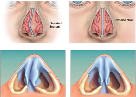 Endoscopic Septoplasty