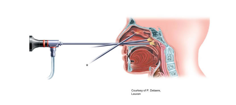 Sinus Video Endoscopy