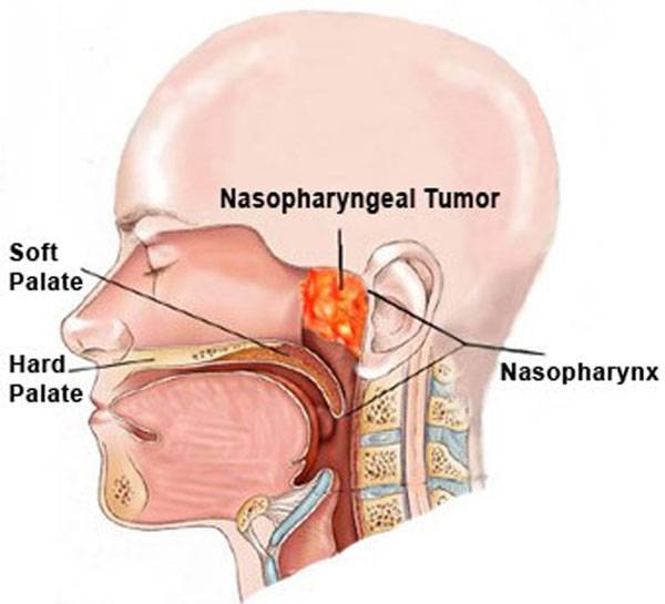 Head and Neck Cancer