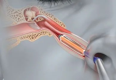 Eustachian Balloon Dilation
